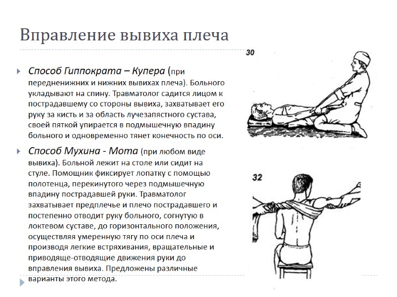Вправление вывиха плеча Способ Гиппократа – Купера (при передненижних и нижних вывихах плеча). Больного